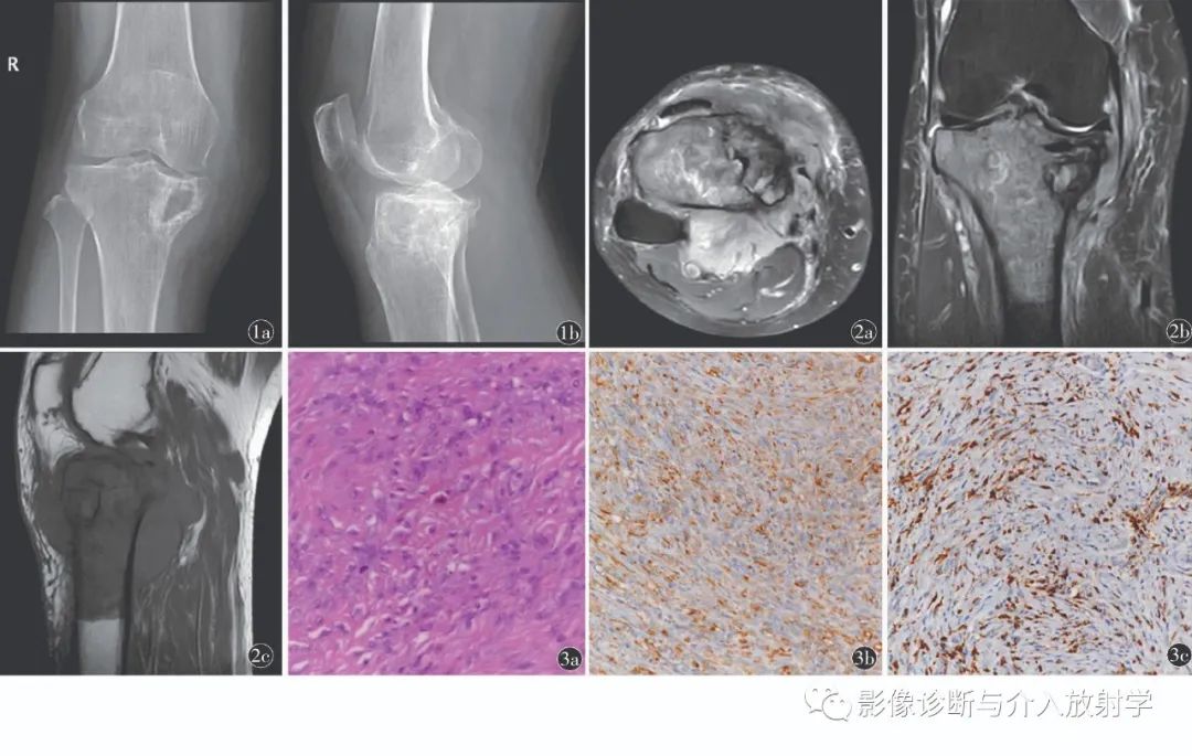 影像PPT - 【病例】胫骨骨内原发恶性腱鞘巨细胞瘤一例X线MR-2 影像PPT - 【病例】胫骨骨内原发恶性腱鞘巨细胞瘤一例X线MR-2