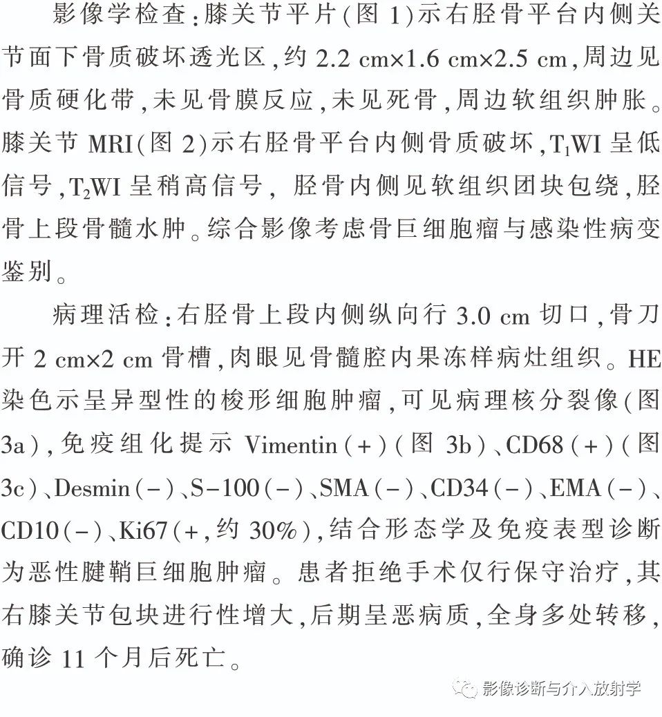 影像PPT - 【病例】胫骨骨内原发恶性腱鞘巨细胞瘤一例X线MR-1 影像PPT - 【病例】胫骨骨内原发恶性腱鞘巨细胞瘤一例X线MR-1