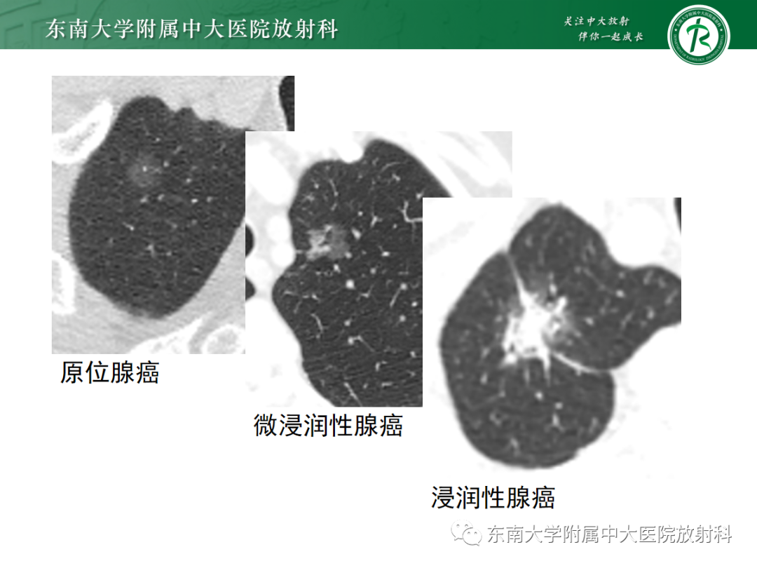 影像PPT - 【PPT】基于病理基础的肺腺癌影像学表现-4