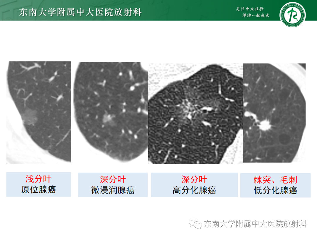 影像PPT - 【PPT】基于病理基础的肺腺癌影像学表现-10
