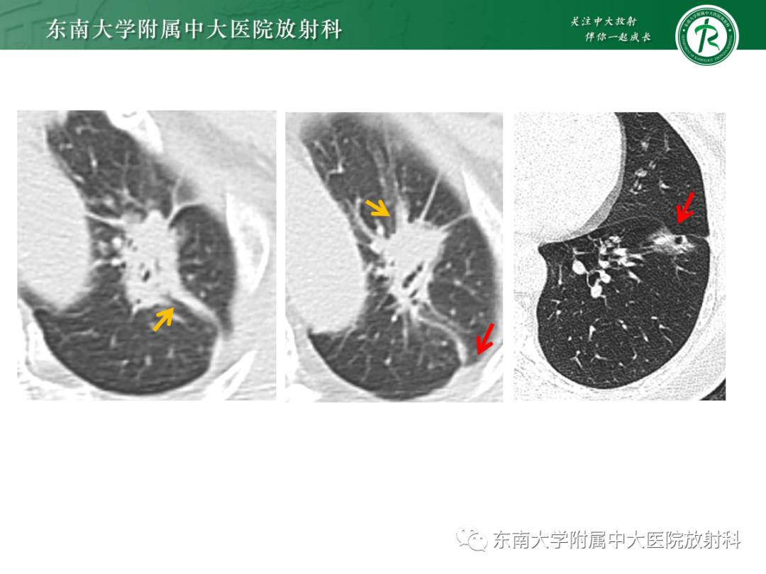 影像PPT - 【PPT】基于病理基础的肺腺癌影像学表现-12