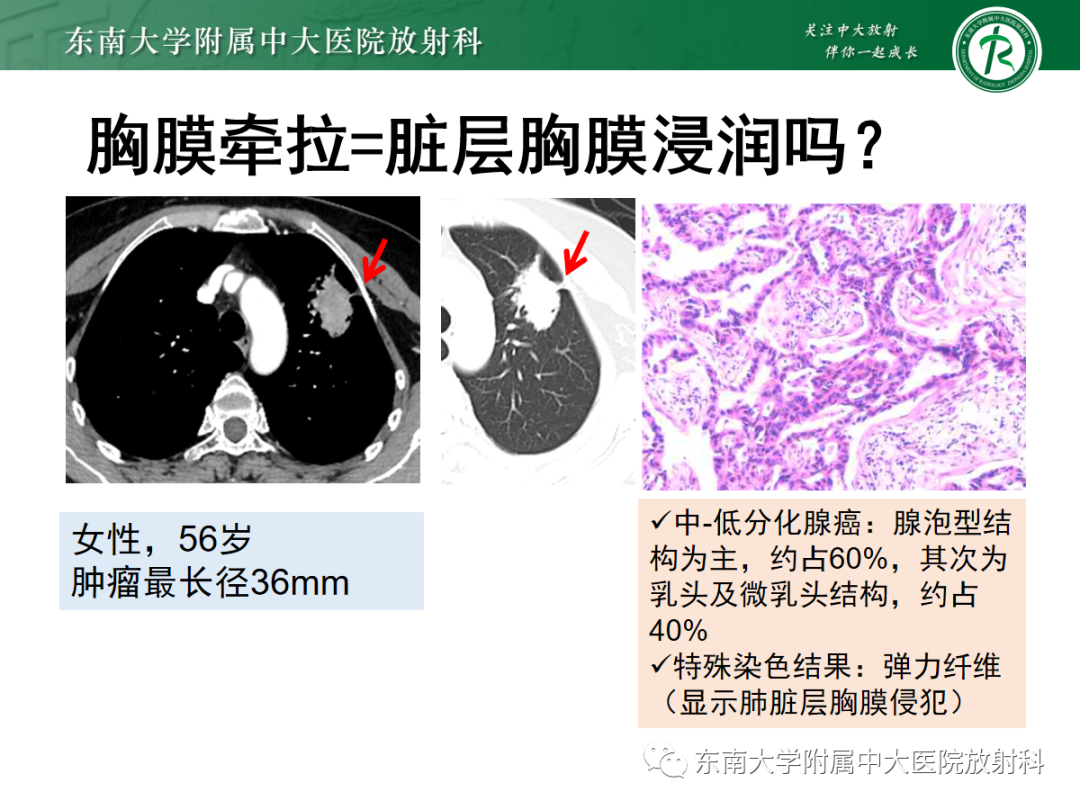 影像PPT - 【PPT】基于病理基础的肺腺癌影像学表现-13