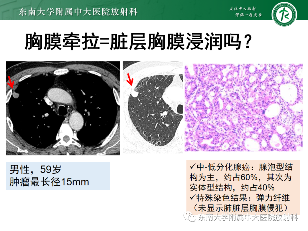 影像PPT - 【PPT】基于病理基础的肺腺癌影像学表现-14