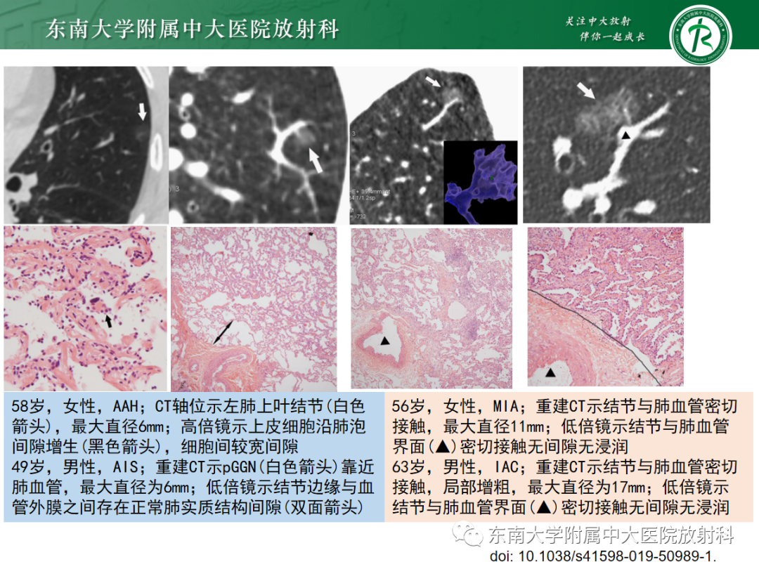 影像PPT - 【PPT】基于病理基础的肺腺癌影像学表现-16