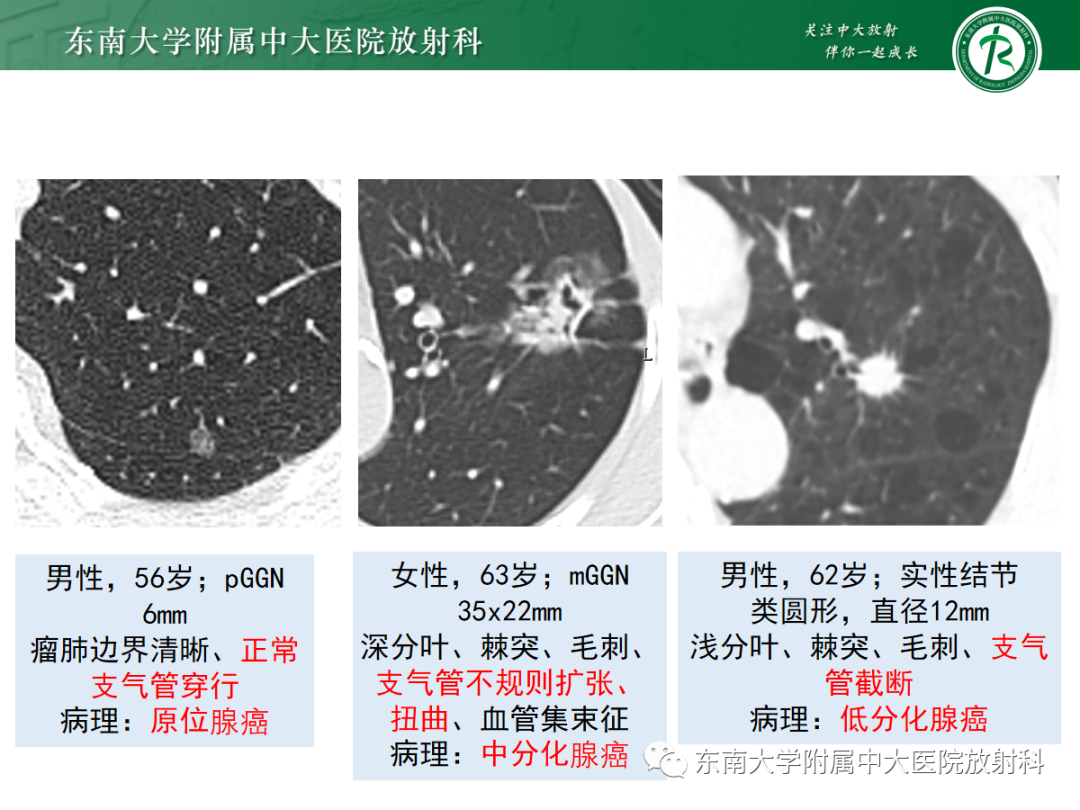 影像PPT - 【PPT】基于病理基础的肺腺癌影像学表现-18