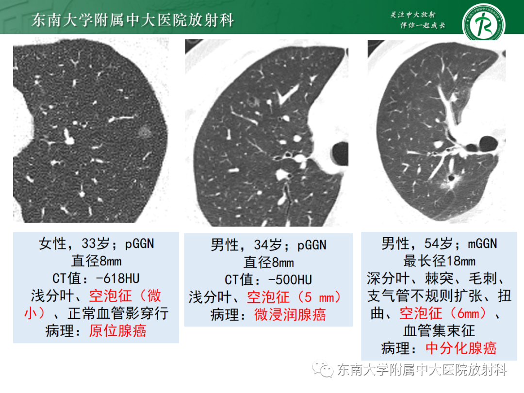 影像PPT - 【PPT】基于病理基础的肺腺癌影像学表现-20