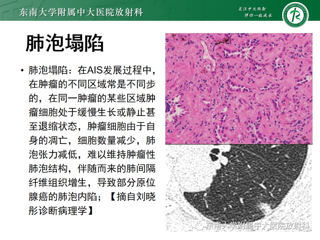 影像PPT - 【PPT】基于病理基础的肺腺癌影像学表现-24