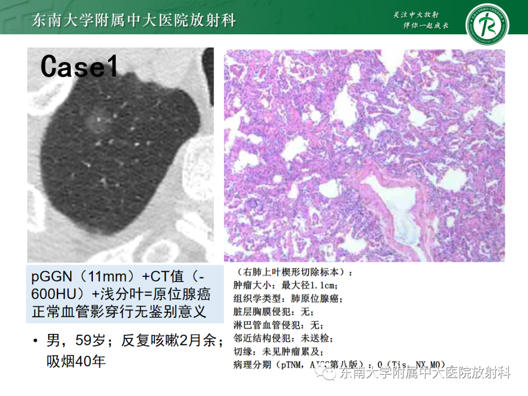 影像PPT - 【PPT】基于病理基础的肺腺癌影像学表现-26