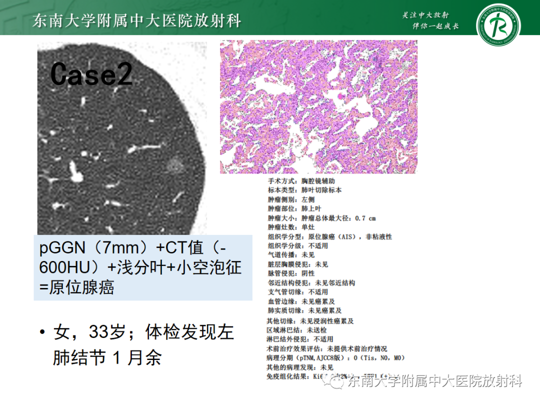 影像PPT - 【PPT】基于病理基础的肺腺癌影像学表现-27