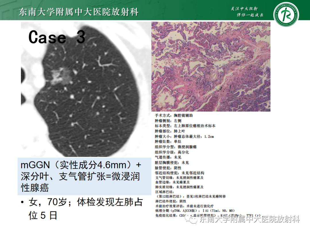影像PPT - 【PPT】基于病理基础的肺腺癌影像学表现-30