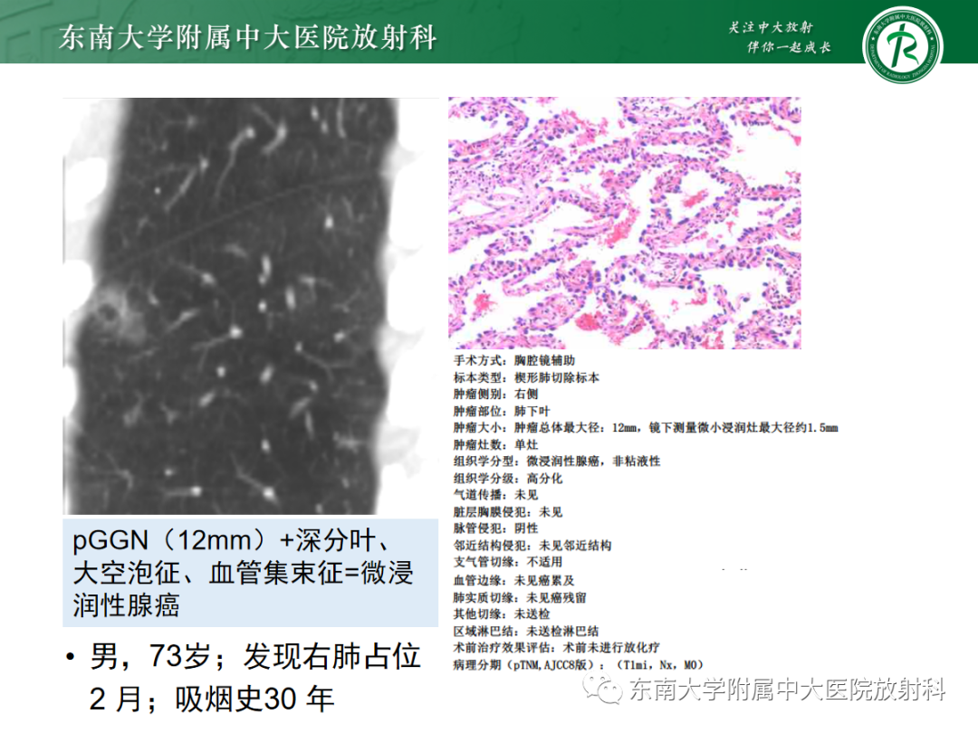 影像PPT - 【PPT】基于病理基础的肺腺癌影像学表现-31