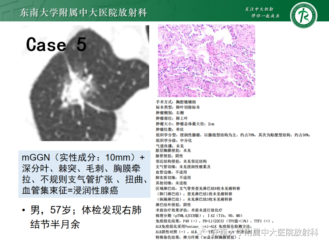 影像PPT - 【PPT】基于病理基础的肺腺癌影像学表现-35