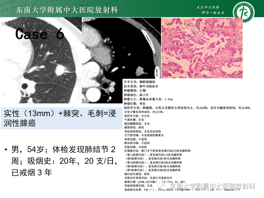 影像PPT - 【PPT】基于病理基础的肺腺癌影像学表现-36