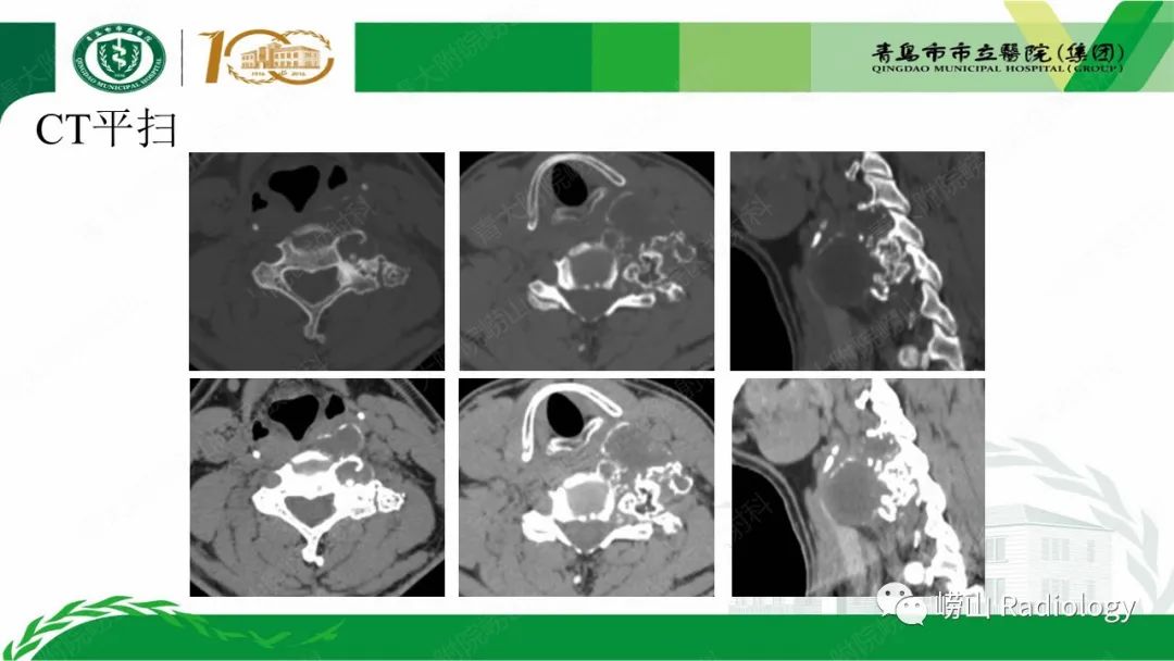 影像PPT - 【病例】继发型软骨肉瘤1例CT及MR影像-4
