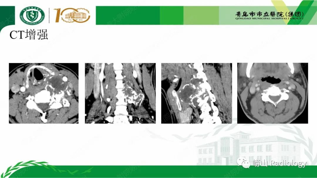 影像PPT - 【病例】继发型软骨肉瘤1例CT及MR影像-5