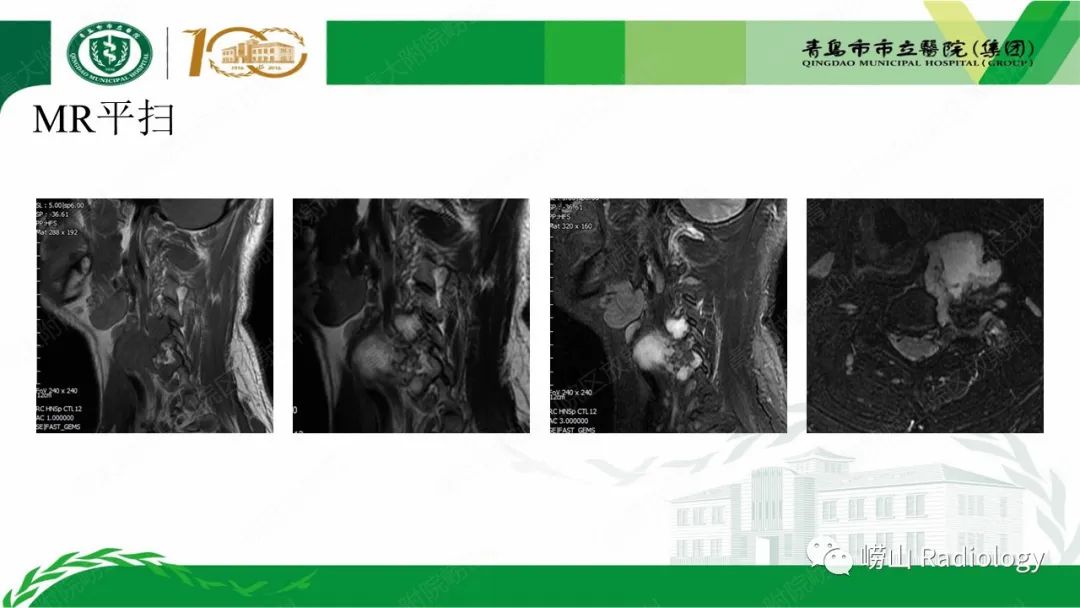 影像PPT - 【病例】继发型软骨肉瘤1例CT及MR影像-6