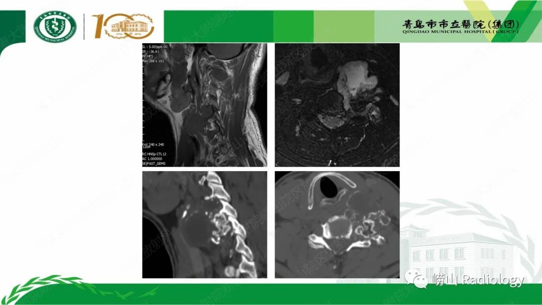 影像PPT - 【病例】继发型软骨肉瘤1例CT及MR影像-7
