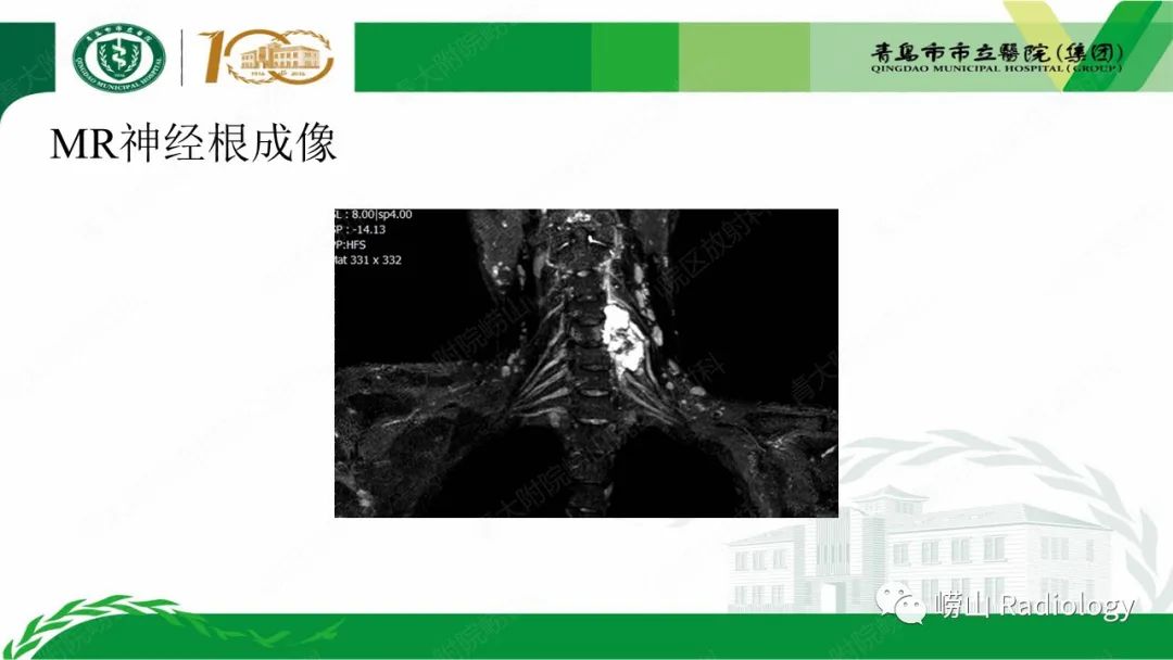 影像PPT - 【病例】继发型软骨肉瘤1例CT及MR影像-8