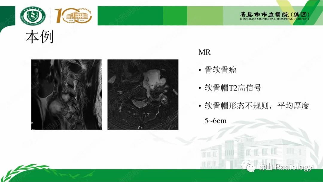 影像PPT - 【病例】继发型软骨肉瘤1例CT及MR影像-14