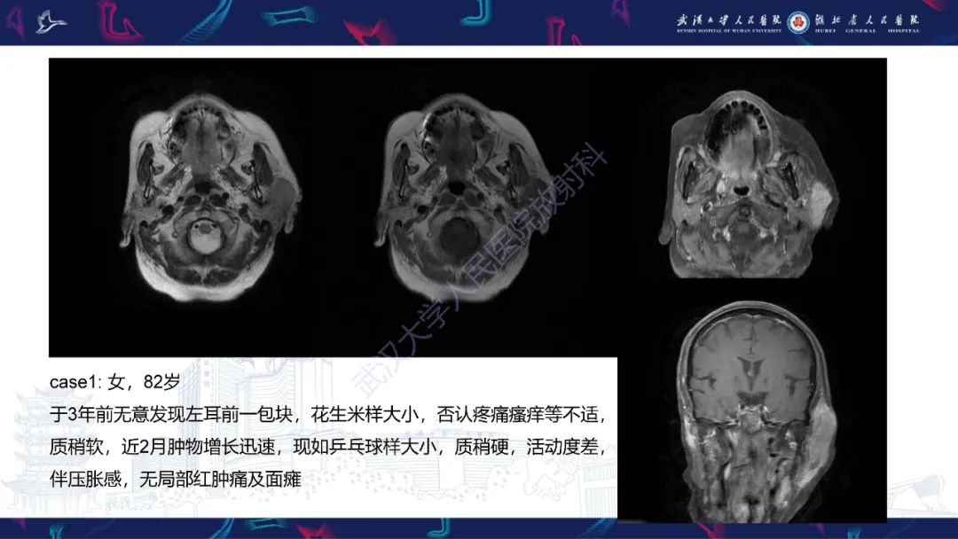 影像PPT - 【PPT】腮腺原发性淋巴瘤影像诊断-2