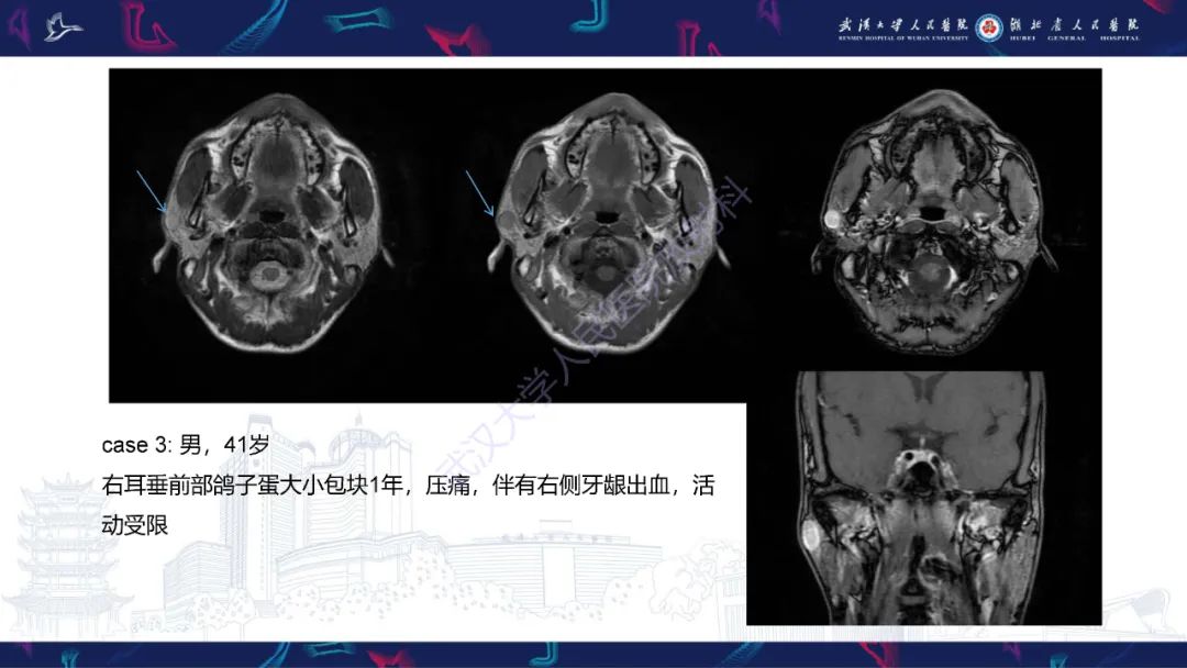 影像PPT - 【PPT】腮腺原发性淋巴瘤影像诊断-4