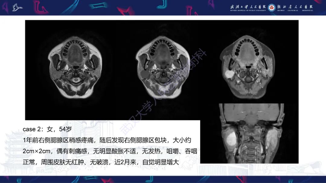 影像PPT - 【PPT】腮腺原发性淋巴瘤影像诊断-3