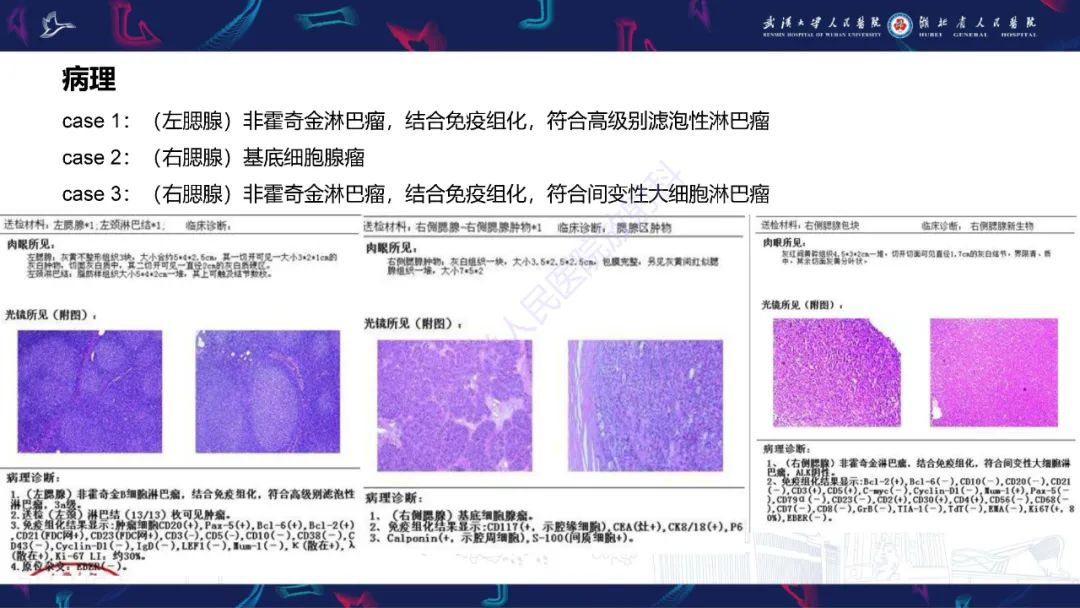影像PPT - 【PPT】腮腺原发性淋巴瘤影像诊断-5