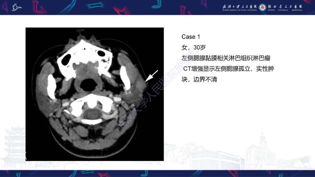 影像PPT - 【PPT】腮腺原发性淋巴瘤影像诊断-11