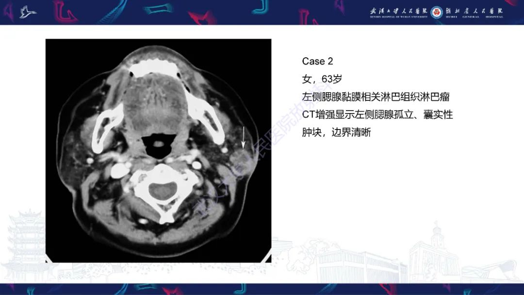 影像PPT - 【PPT】腮腺原发性淋巴瘤影像诊断-12