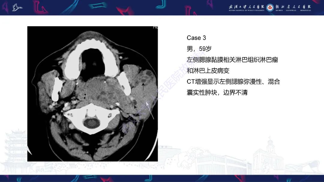 影像PPT - 【PPT】腮腺原发性淋巴瘤影像诊断-13