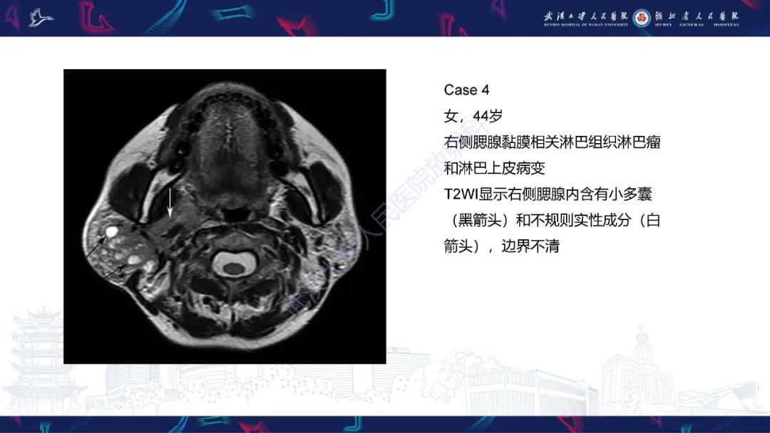 影像PPT - 【PPT】腮腺原发性淋巴瘤影像诊断-14