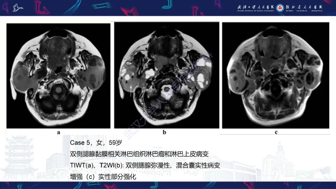 影像PPT - 【PPT】腮腺原发性淋巴瘤影像诊断-15
