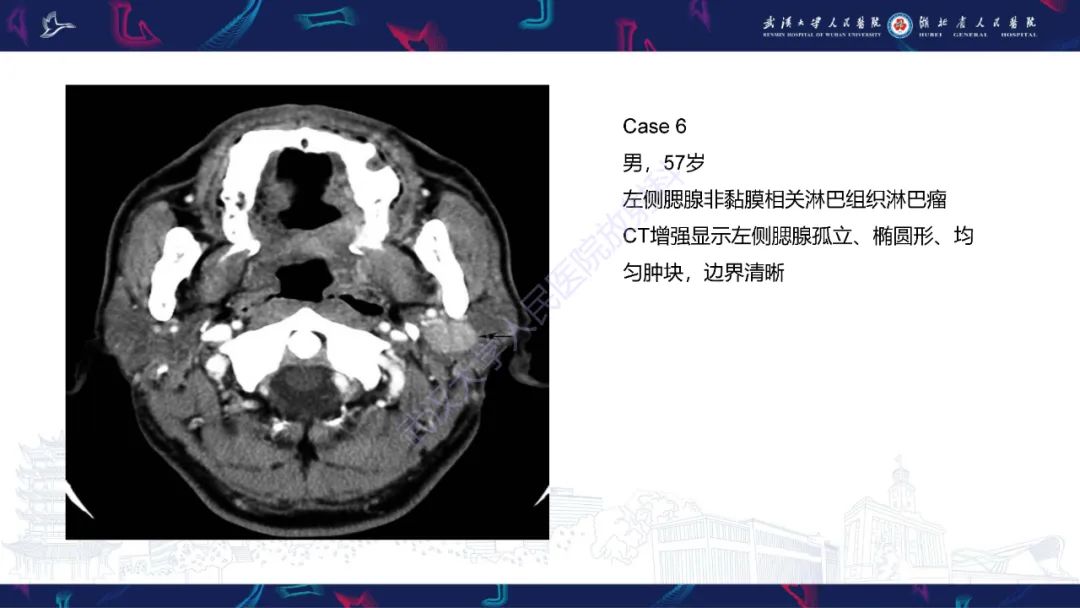 影像PPT - 【PPT】腮腺原发性淋巴瘤影像诊断-16