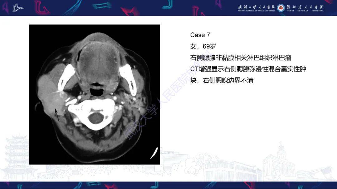 影像PPT - 【PPT】腮腺原发性淋巴瘤影像诊断-17