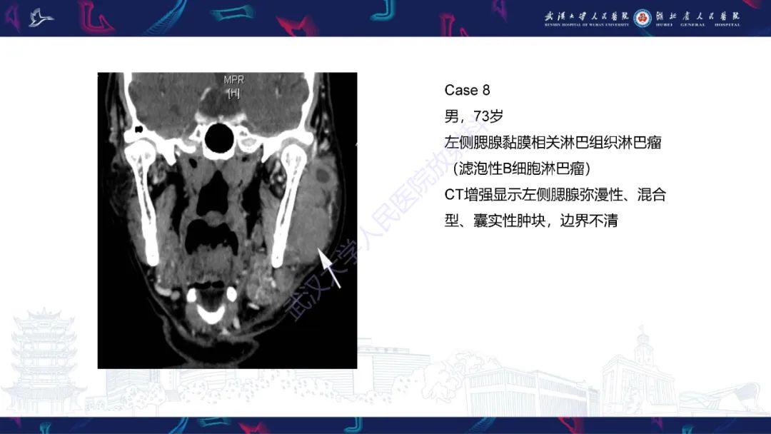 影像PPT - 【PPT】腮腺原发性淋巴瘤影像诊断-18