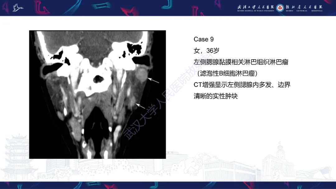 影像PPT - 【PPT】腮腺原发性淋巴瘤影像诊断-19