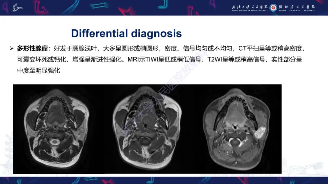 影像PPT - 【PPT】腮腺原发性淋巴瘤影像诊断-20