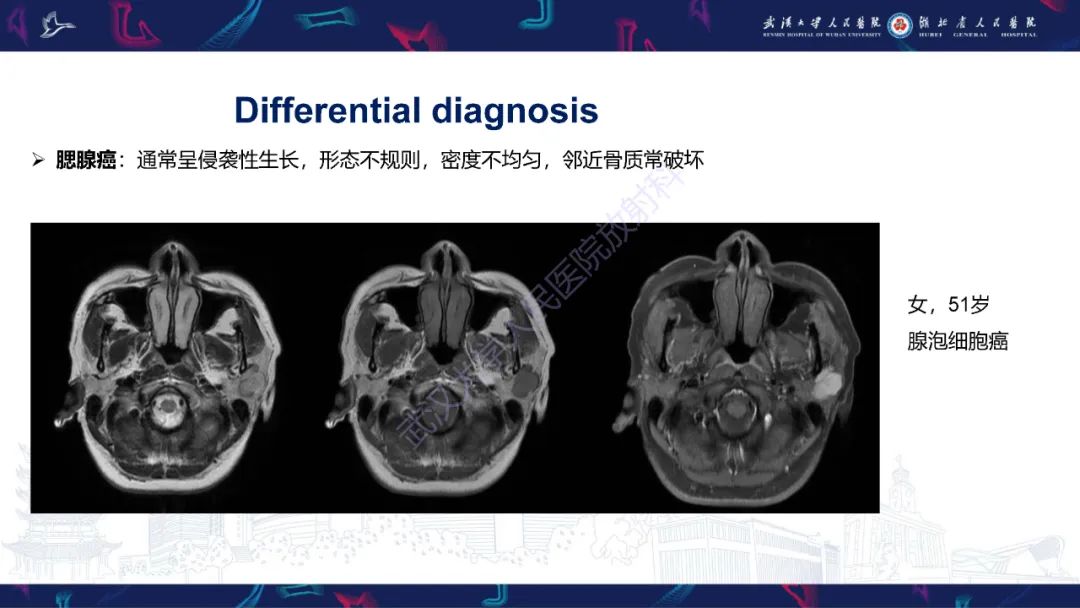 影像PPT - 【PPT】腮腺原发性淋巴瘤影像诊断-22