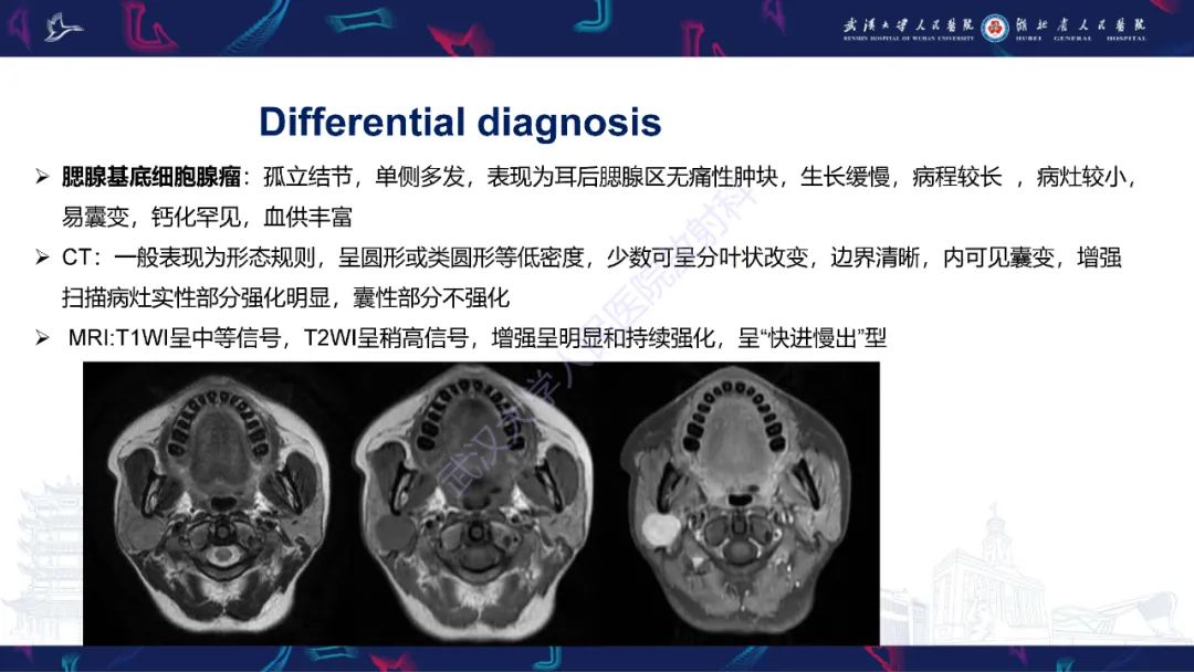 影像PPT - 【PPT】腮腺原发性淋巴瘤影像诊断-21