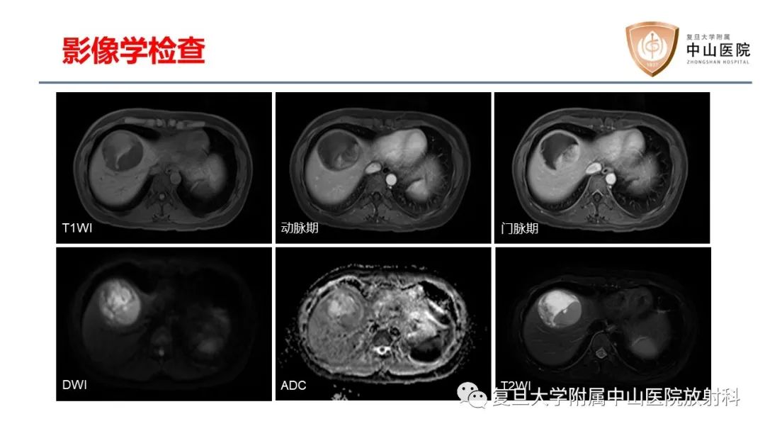 影像PPT - 【病例】肝脏未分化胚胎性肉瘤2例MR影像-3