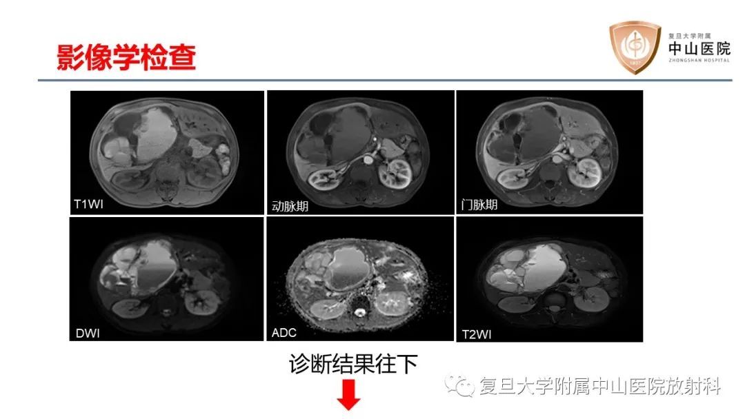 影像PPT - 【病例】肝脏未分化胚胎性肉瘤2例MR影像-5