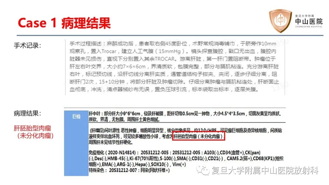 影像PPT - 【病例】肝脏未分化胚胎性肉瘤2例MR影像-6