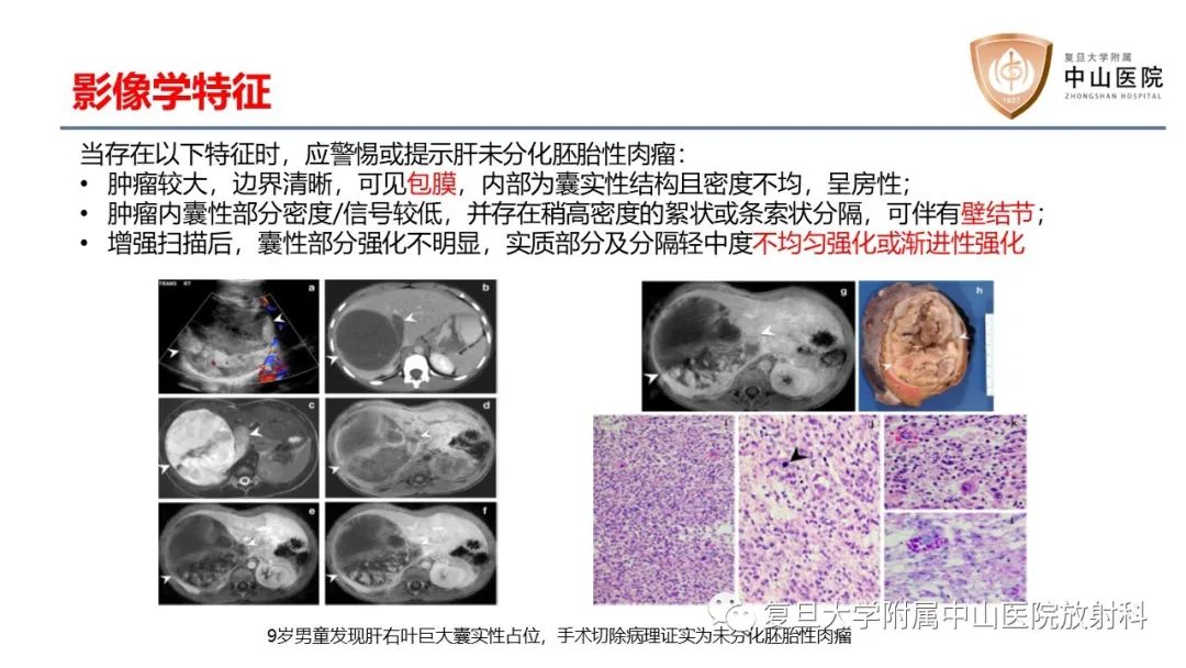 影像PPT - 【病例】肝脏未分化胚胎性肉瘤2例MR影像-11