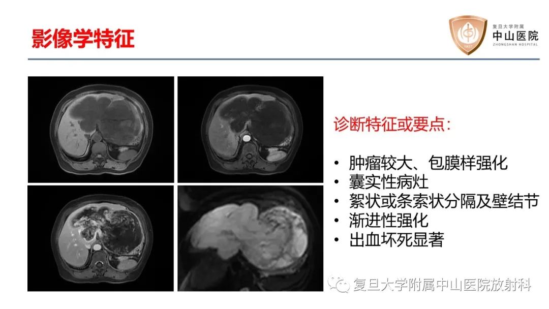 影像PPT - 【病例】肝脏未分化胚胎性肉瘤2例MR影像-12