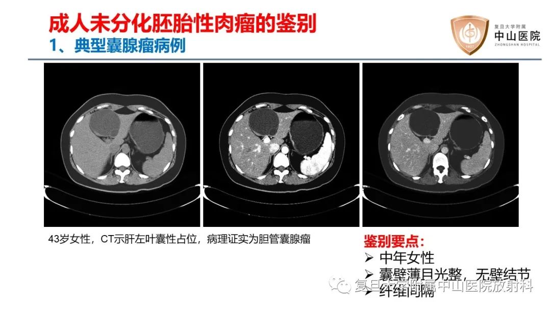 影像PPT - 【病例】肝脏未分化胚胎性肉瘤2例MR影像-16