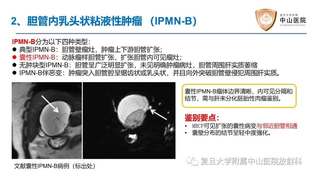 影像PPT - 【病例】肝脏未分化胚胎性肉瘤2例MR影像-17