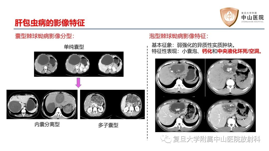 影像PPT - 【病例】肝脏未分化胚胎性肉瘤2例MR影像-19