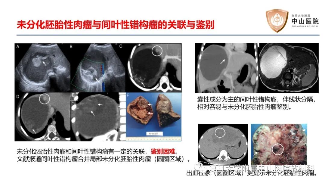 影像PPT - 【病例】肝脏未分化胚胎性肉瘤2例MR影像-22