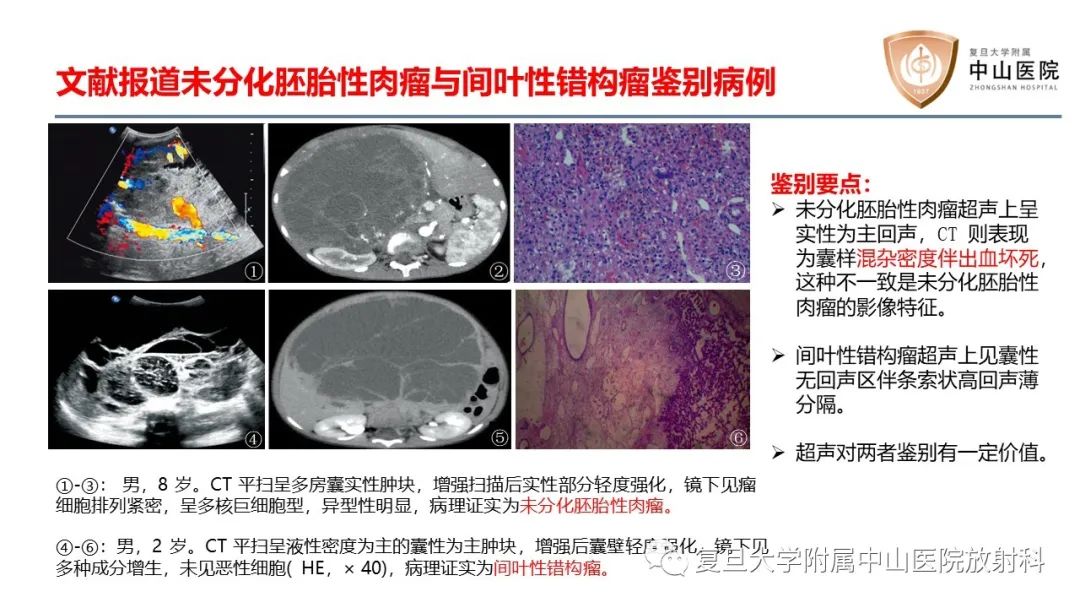 影像PPT - 【病例】肝脏未分化胚胎性肉瘤2例MR影像-23