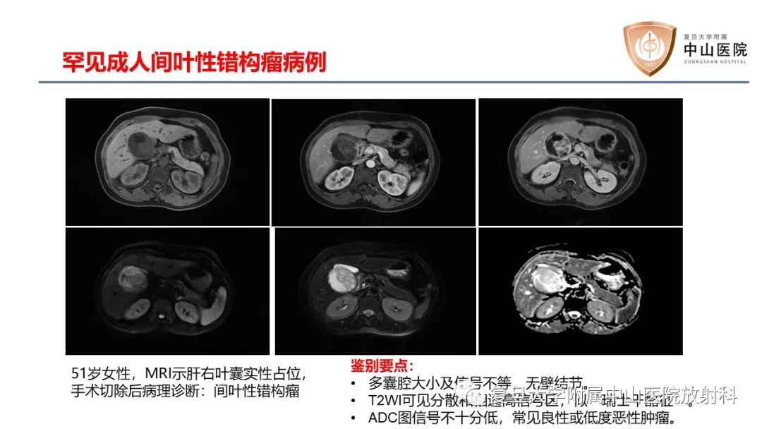 影像PPT - 【病例】肝脏未分化胚胎性肉瘤2例MR影像-24
